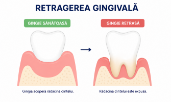 Retragerea gingivală: cauze, simptome, tratament și metode de prevenție
