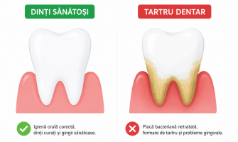 Tartrul dentar: ce este, de ce apare și cum îl poți preveni?